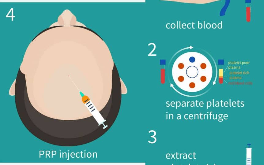 PRP Therapy Treatment