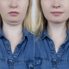 Double Chin Removal in Abu Dhabi