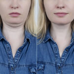 Double Chin Removal in Abu Dhabi