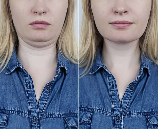 Double Chin Removal in Abu Dhabi